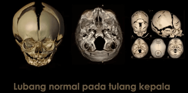 Gambar 8. Lubang normal pada tulang kepala