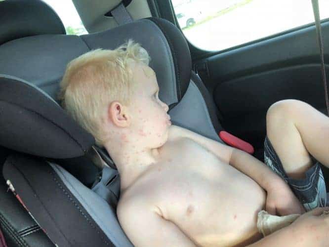 Hunter and bug bites