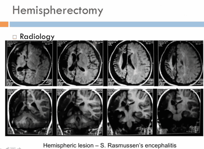 Gambar 8.  Hemisferektomi akibat S. Rasmussen’s encephalitis