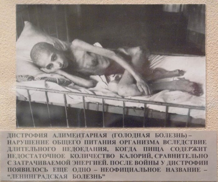 Patiënt met dystrofie als gevolg van hongersnood tijdens de belegering van Leningrad, tentoongesteld in het Museum van de Blokkade.