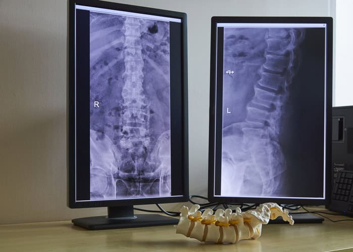 What is Failed Back Surgery Syndrome?