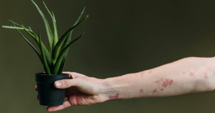 L’Eczéma décrypté avec une approche naturopathique