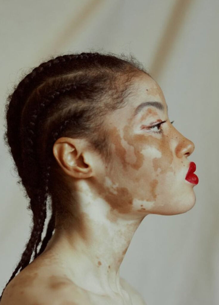 vitiligo