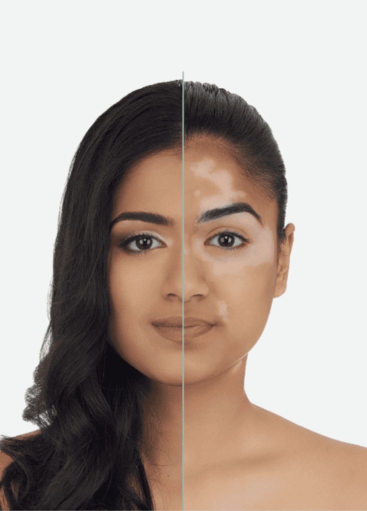vitiligo