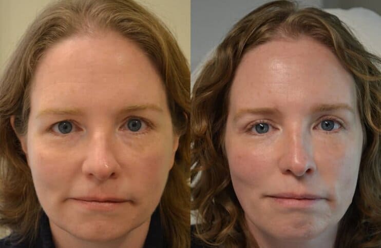 upper-eyelid-surgery-blepharoplasty-before-after-3 bilateral upper blepharoplasty before and after results of a woman aged 40 to 45