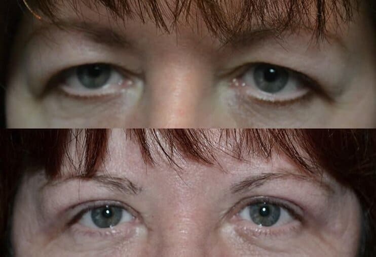 Case22 bilateral upper eyelid surgery before and after photo of a woman aged 30 to 35