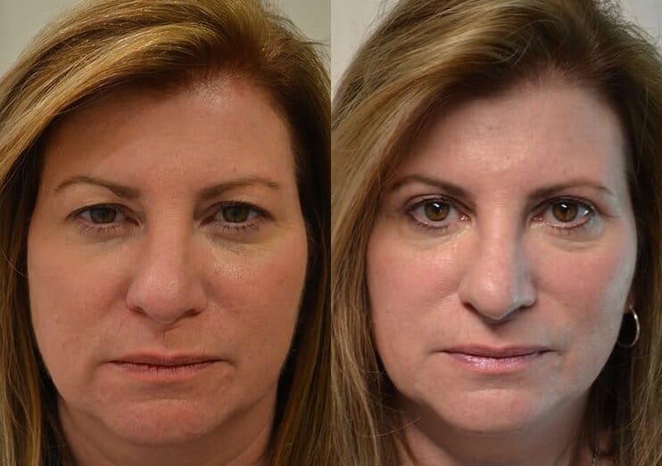 Case12 bilateral upper blepharoplasty before and after results of a woman aged 55 to 60