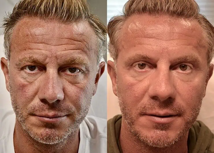 24beforeafter bilateral upper blepharoplasty before and after results of a man aged 45 to 50