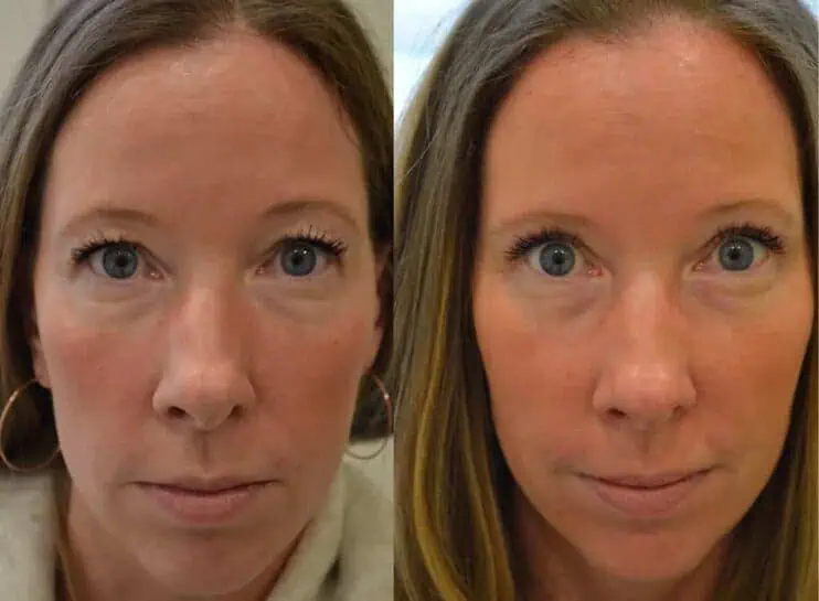 upper-eyelid-surgery-blepharoplasty-before-after-2 bilateral upper eyelid surgery before and after photo of a woman aged 40 to 45
