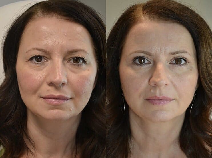 Upper Blepharoplasty Before and After Photos Fresh Face Eye Upper Blepharoplasty Before and After Photos Fresh Face Eye
