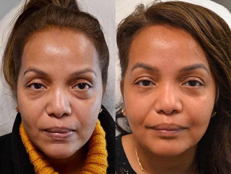 12beforeafter lower eyelid surgery before and after of woman aged 40 to 45 years, fixing dark circles under eyes