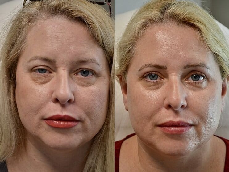 7beforeafter blepharoplasty and ptosis surgery before and after of woman aged 45 to 50