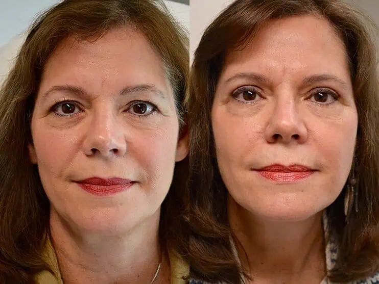 Case14 bilateral upper blepharoplasty before and after results of a woman aged 60 to 65