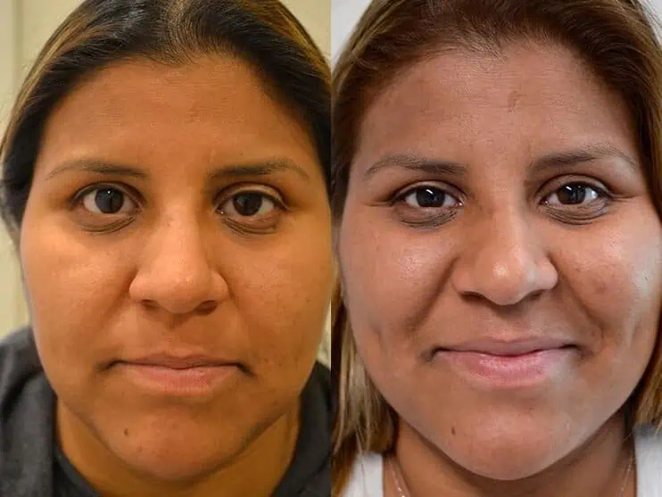 ptosis-repair-6 ptosis surgery before and after of woman aged 30 to 35
