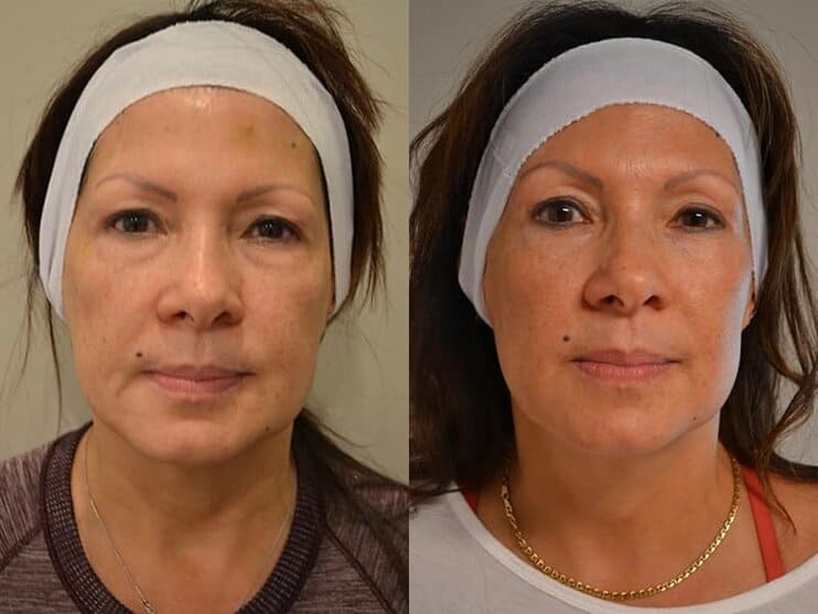 ultherapy-1a before and after of woman's ultherapy treatment for lower face and upper neck