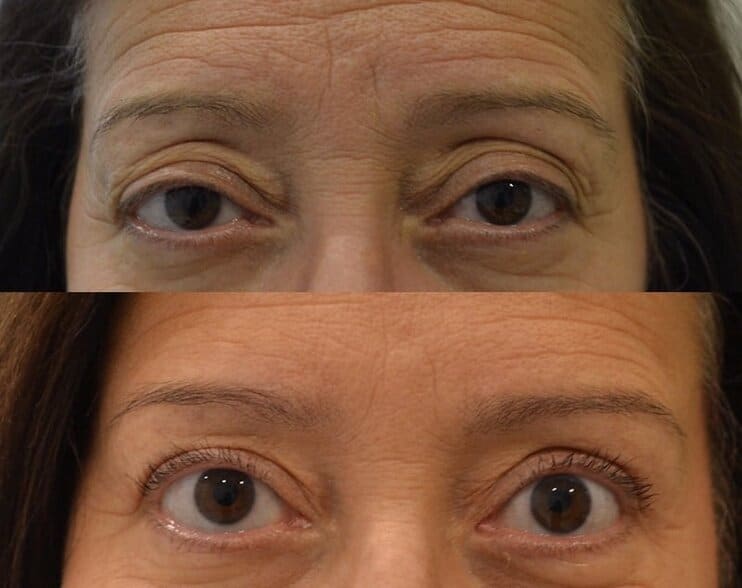 Case23 bilateral upper eyelid surgery before and after photo of a woman aged 45 to 50