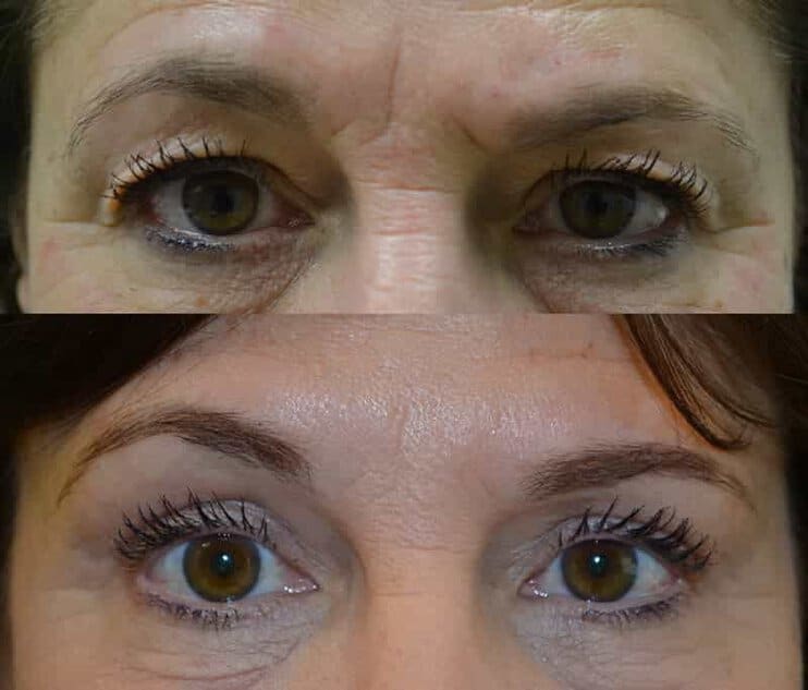 case5 bilateral upper eyelid surgery before and after photo of a woman aged 55 to 60
