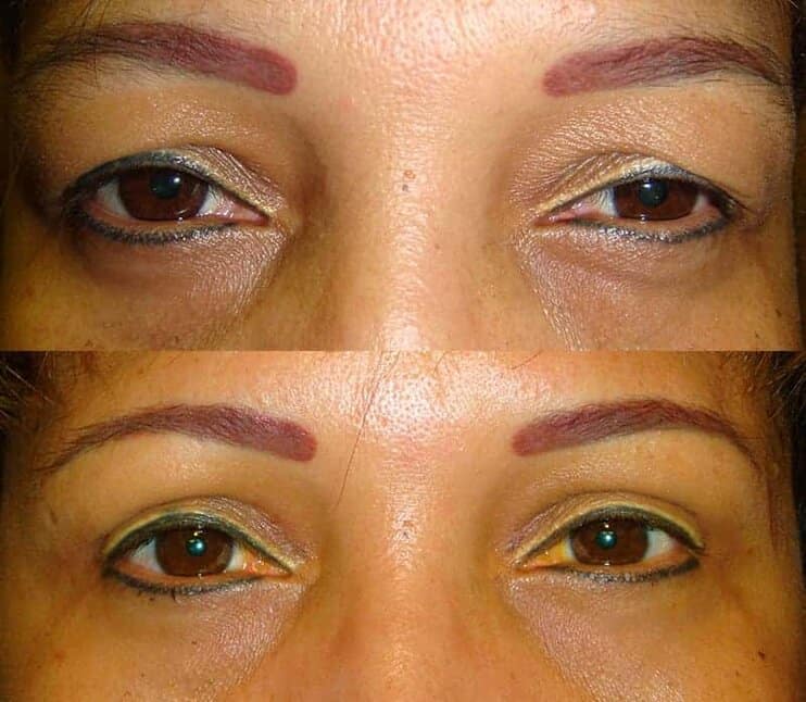 case6 bilateral upper blepharoplasty before and after results of a woman aged 50 to 55, fixing hooded eyelids