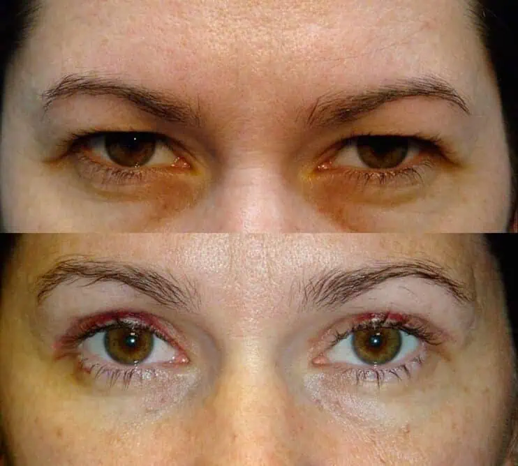 Case17 bilateral upper blepharoplasty before and after results of a woman aged 30 to 35