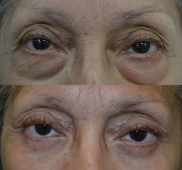 Case7-1 lower blepharoplasty for both eyes of woman aged 65 to 70, addressing puffy bags under eyes
