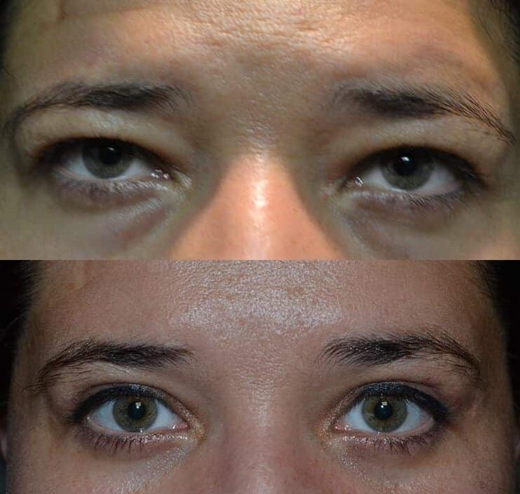 Case11-2 person with hazel eyes before and after for upper and lower blepharoplasty