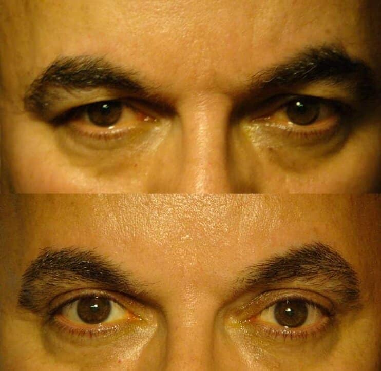 Case10 upper eyelid surgery before and after results of a man aged 50 to 55