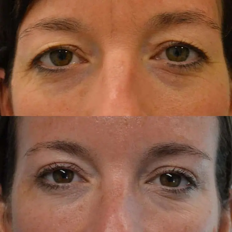 Case11 bilateral upper blepharoplasty before and after results of a woman aged 45 to 50, fixing heavy eyelids