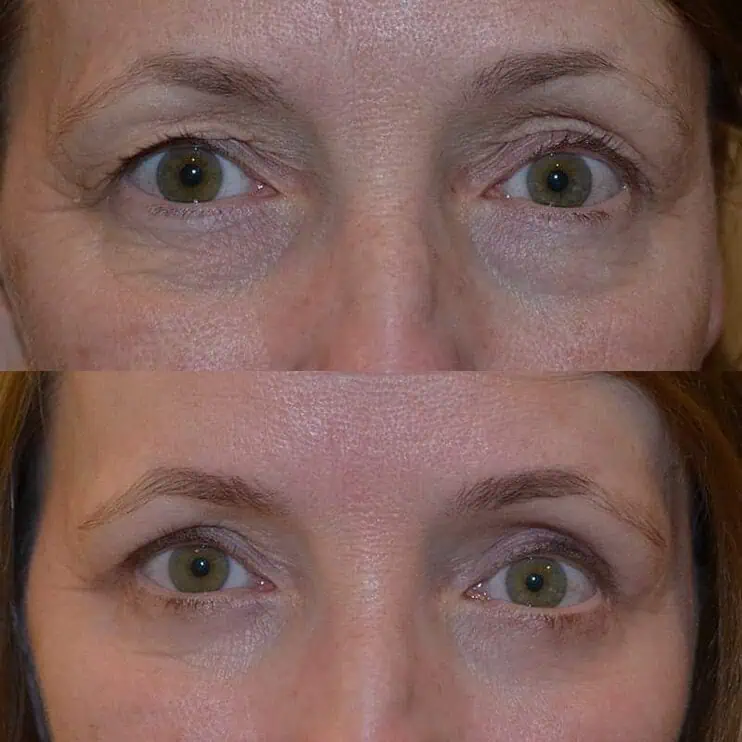 Case12-2 woman with hazel eyes before and after for upper and lower blepharoplasty