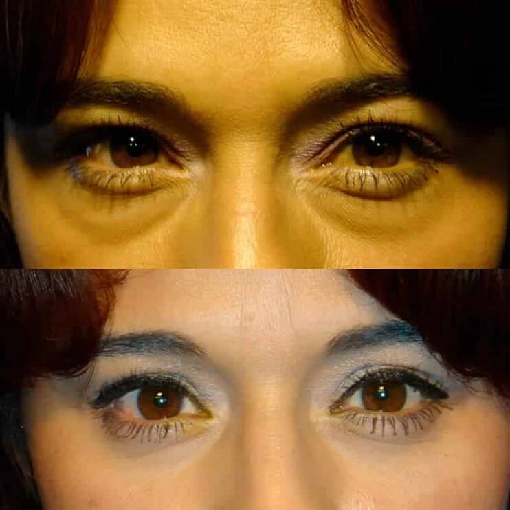 Case5 under eye blepharoplasty before and after for woman aged 30 to 35, fixing puffy bags under eyes