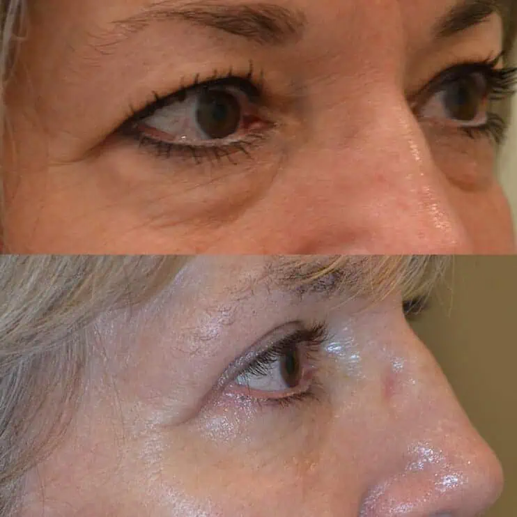 case16b upper and lower blepharoplasty before and after for woman with brown eyes, from the right side