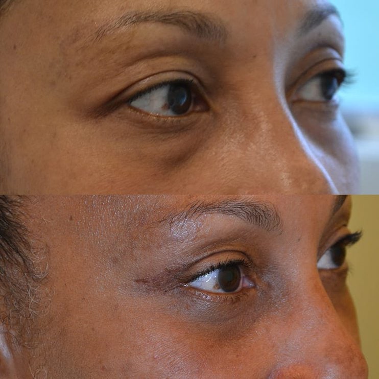 case4b woman with brown eyes before and after for lower and upper blepharoplasty, from the right side