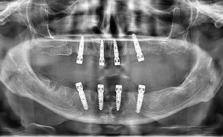 All-on-4 implant treatment – ​​restoration of the entire jaw