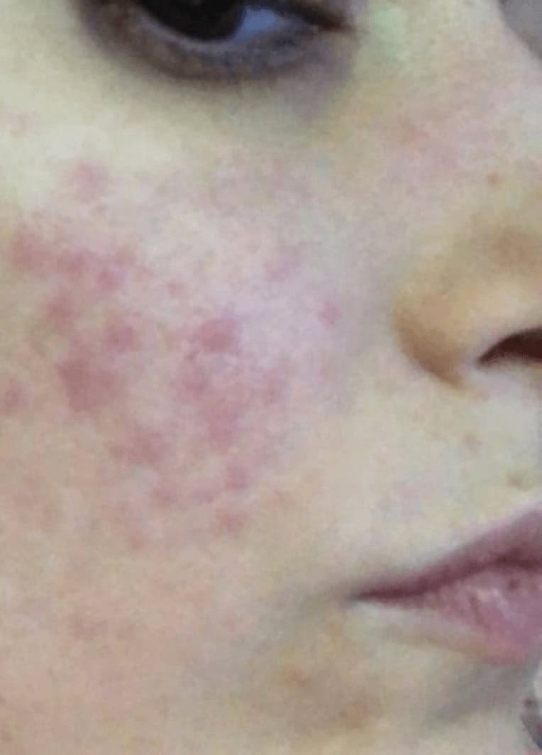 quebrei a perna acne