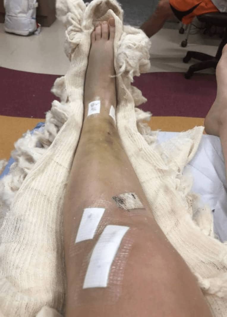 quebrei a perna depois da cirurgia