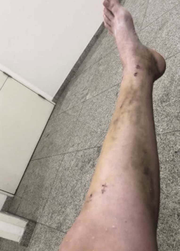 quebrei a perna machucados