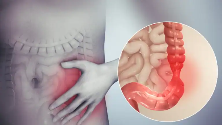Síndrome do Intestino Irritável Dieta para Diverticulite