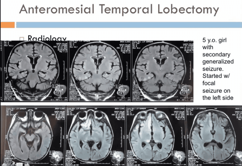 Gambar 6. Anteromesial Temporal Lobectomy
