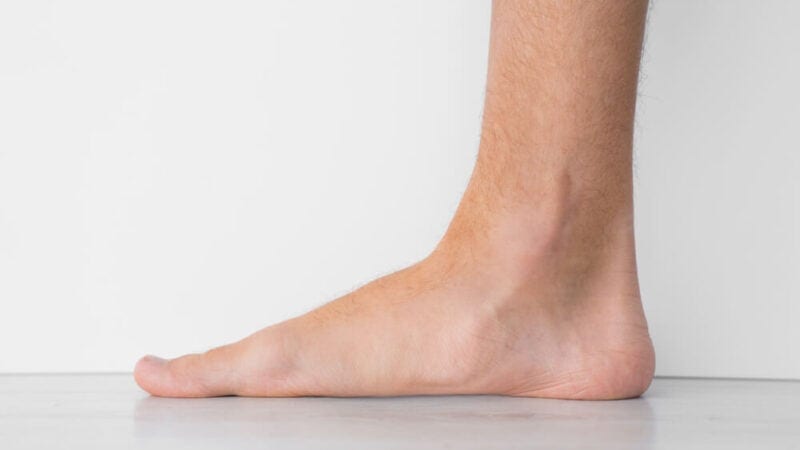 Living Well with Flat Feet – Tips and Insights