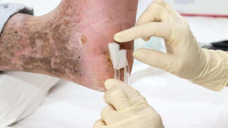 7 Tips for Treating a Diabetic Foot Ulcer