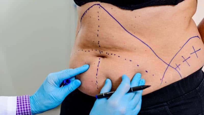 3 Types of Tummy Tuck and What Each One Is Actually Built For