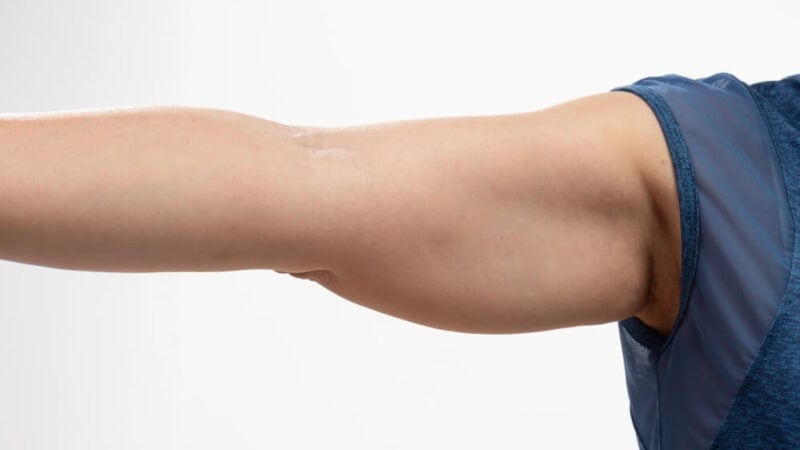 5 Signs an Arm Lift May Be the Right Solution for Loose Arm Skin