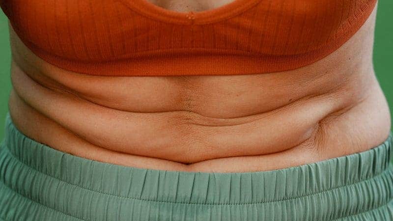 5 Things Moms Should Know Before Considering Liposuction