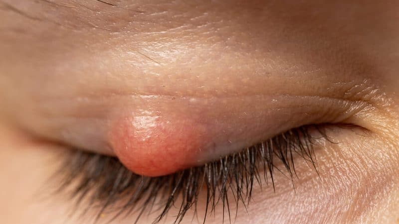 Can a Chalazion Go Away on Its Own, or Does It Need Treatment?