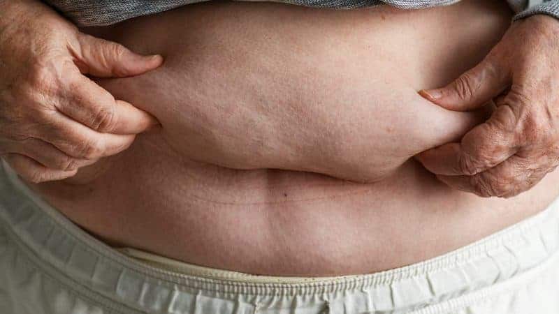 How a Tummy Tuck Can Support an Active Lifestyle in Your 60s