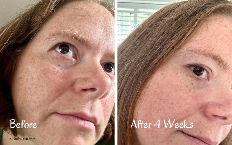 Before and After - Real Results - JOVS Red Light Therapy Mask