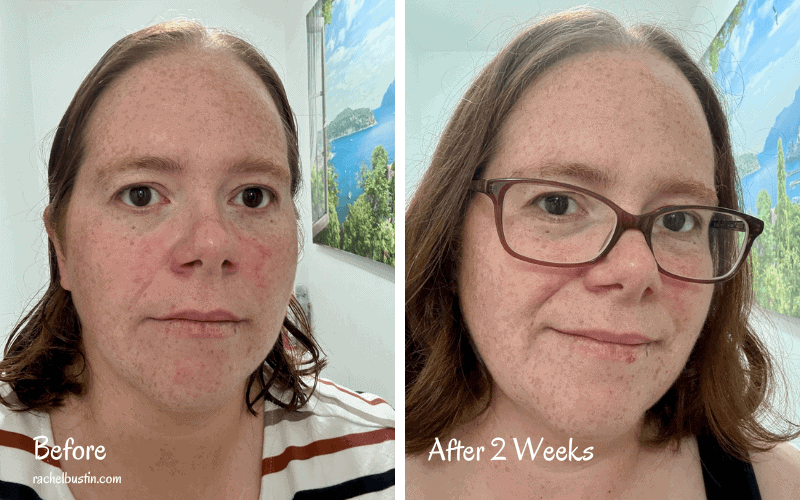 CurrentBody LED Red Light Therapy Face Mask Series 2 Before and After