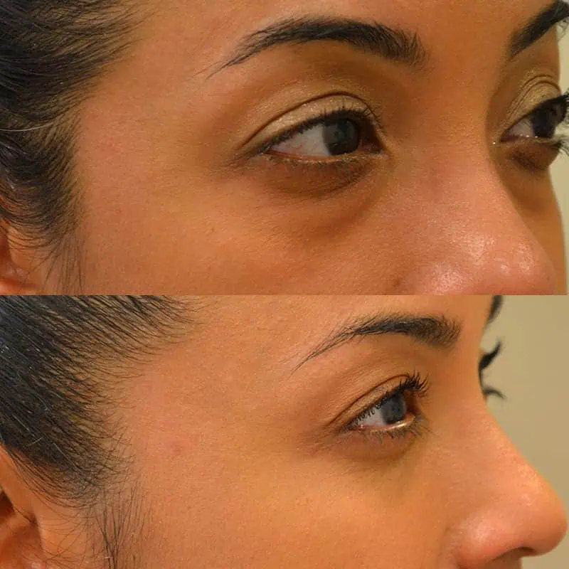 case4b-1 lower blepharoplasty before and after photos of a 40 year old woman's right side