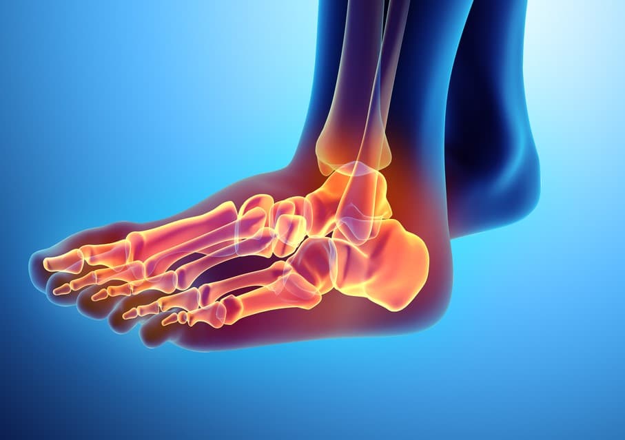 Ankle Fusion Causes, Surgery, Recovery and PostSurgery Mobility