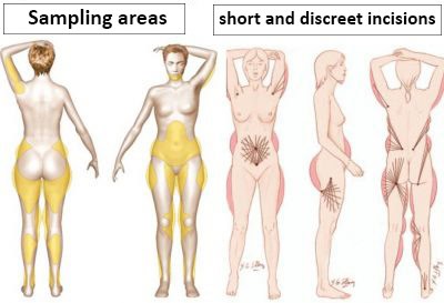 lipofilling corps