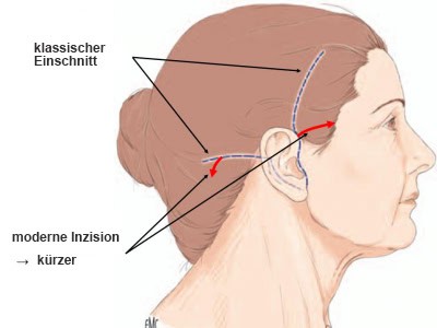 lifting cervico facial